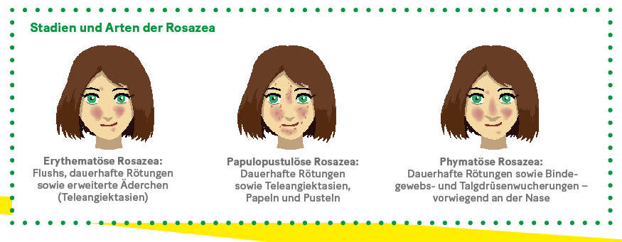 Grafik: Stadien und Arten der Rosazea