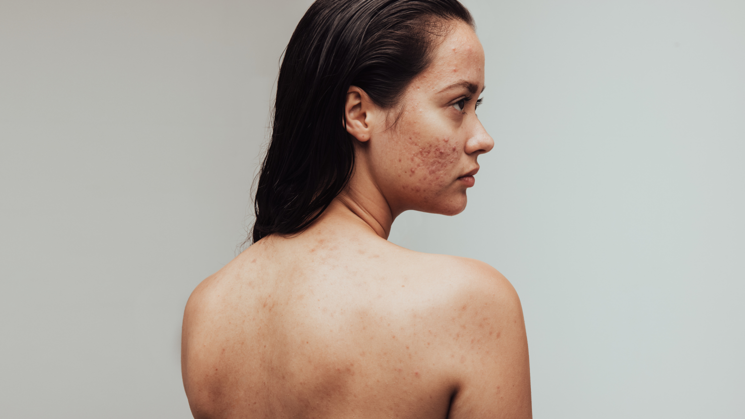 Eine Frau steht mit dem Rücken zur Kamera, auf ihrer Wange sieht man ihre Akne.