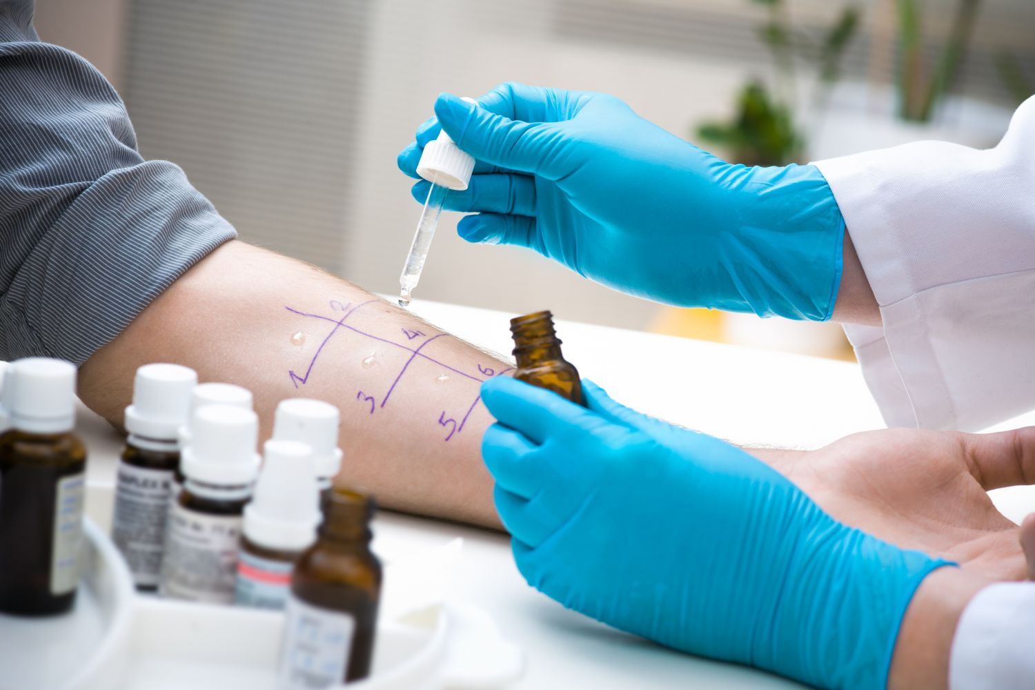 Ein Arzt führt einen Allergietest am Arm eines Patienten durch; Thema: Neurodermitis-Auslöser
